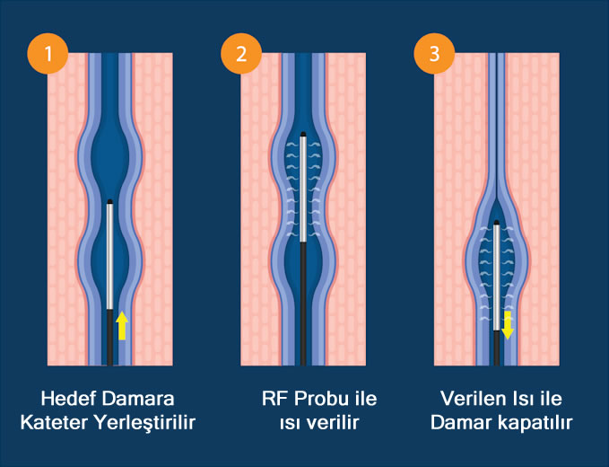 radyofrekansla varis tedavisi