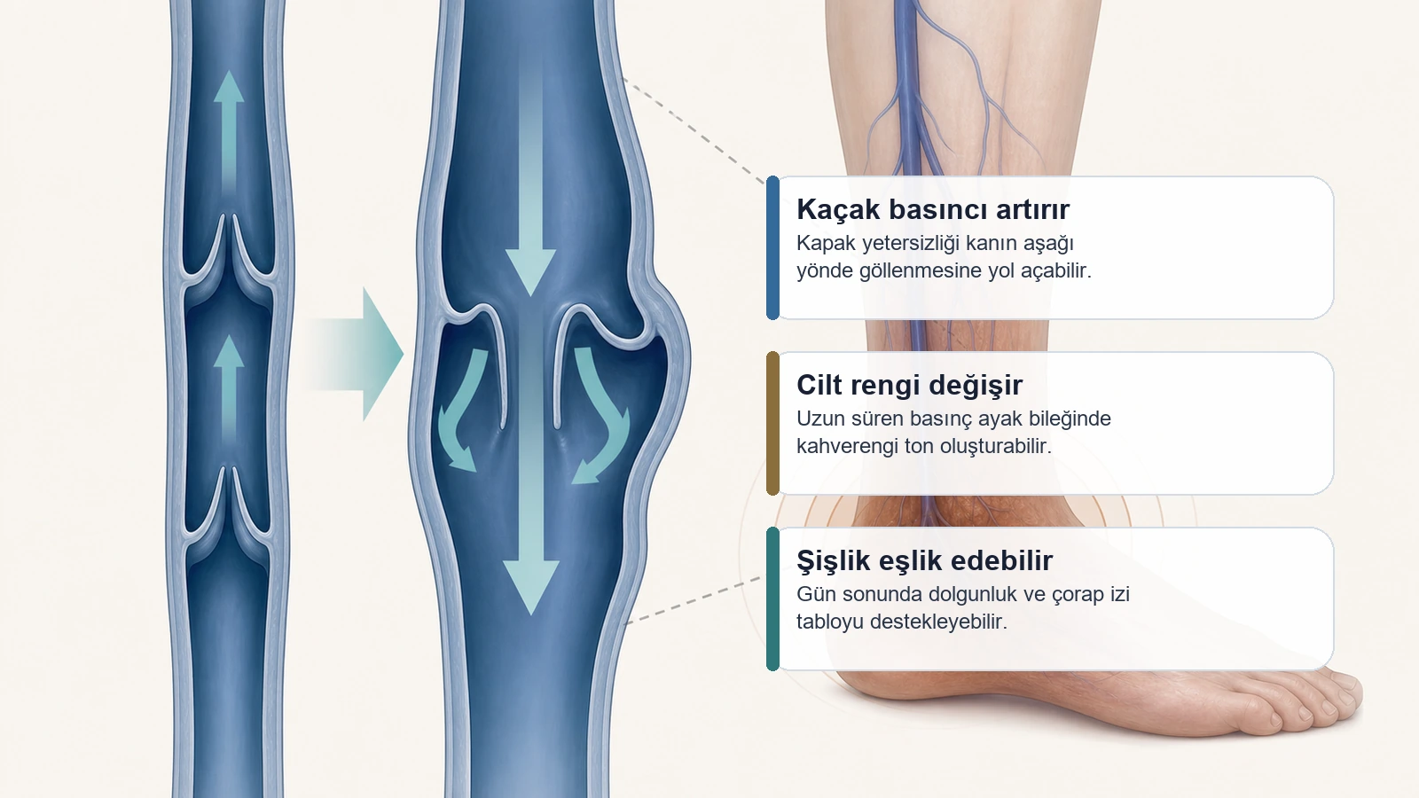 Venöz kaçak ve ayak bileğinde kahverengi cilt lekesi mekanizmasını anlatan görsel