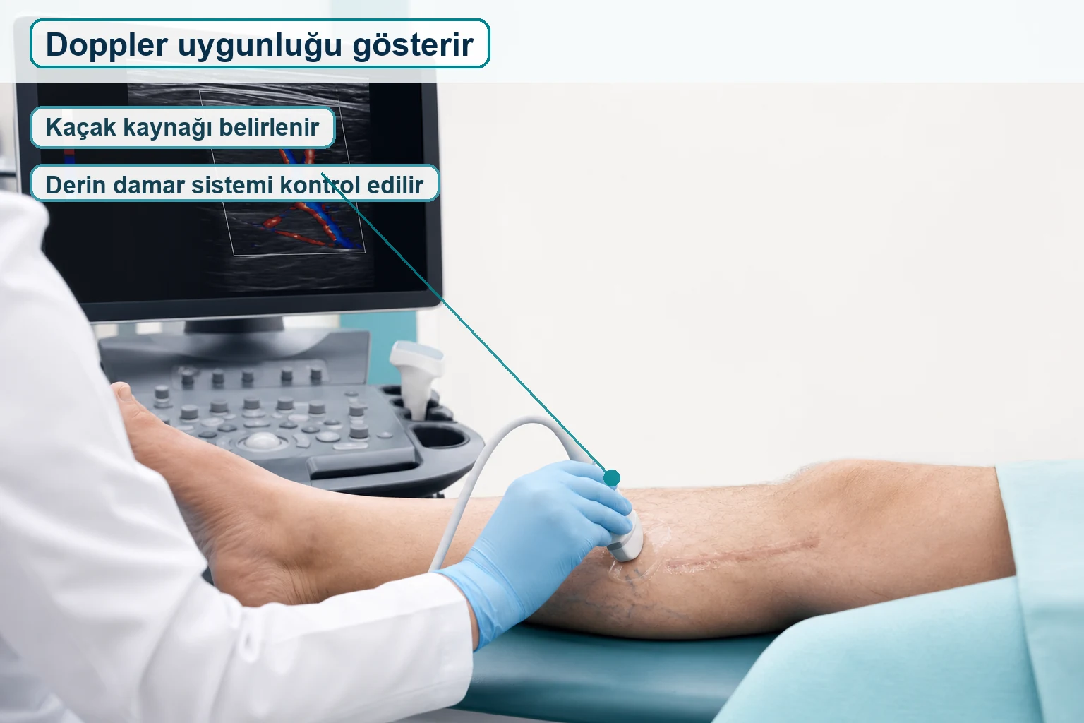 Varis ameliyatı sonrası Doppler ultrasonla kaçak kaynağı ve derin damar sisteminin kontrol edilmesini gösteren görsel