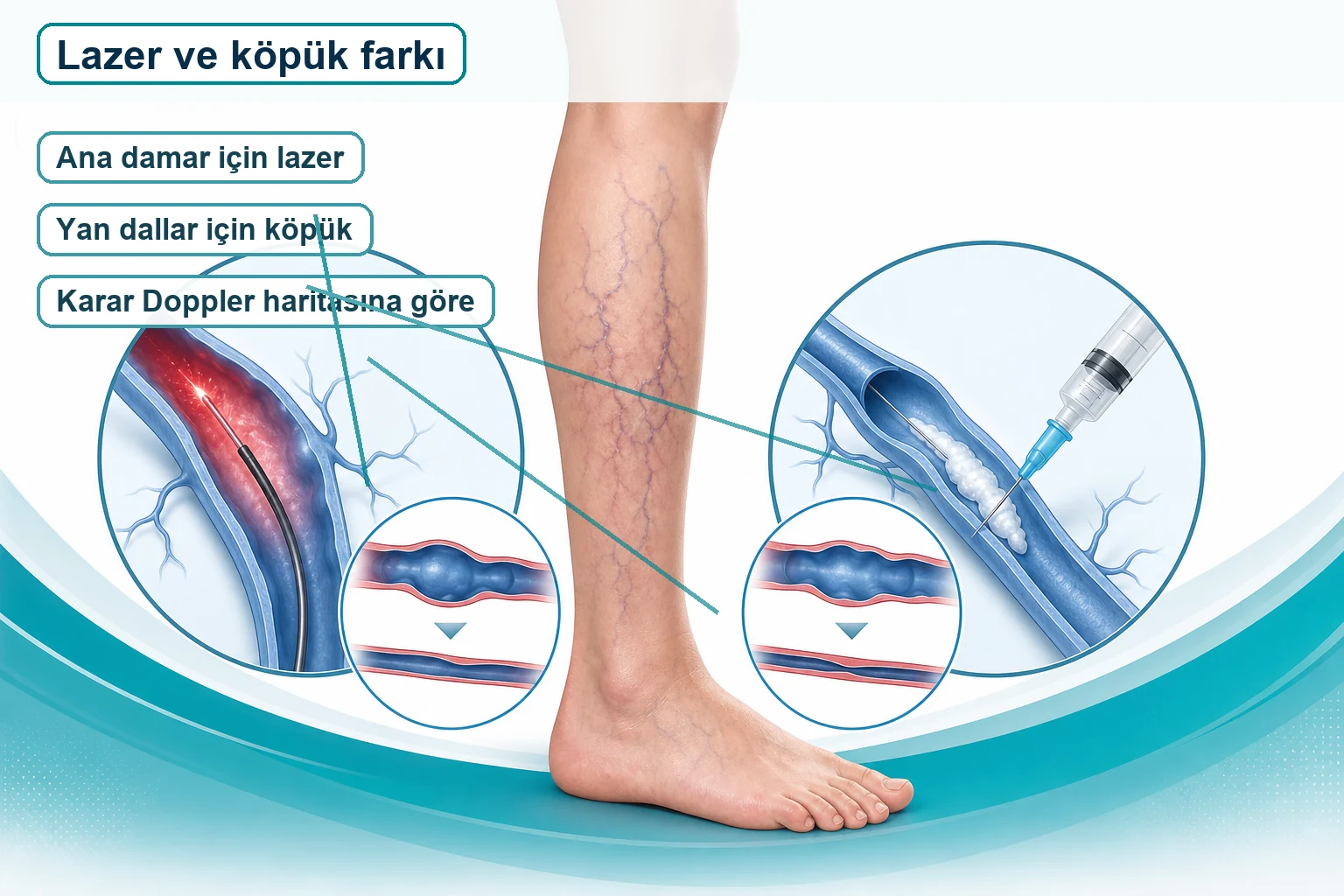 Daha önce varis ameliyatı olanlarda ana damar için lazer ve yan dallar için köpük tedavisi mantığını gösteren görsel