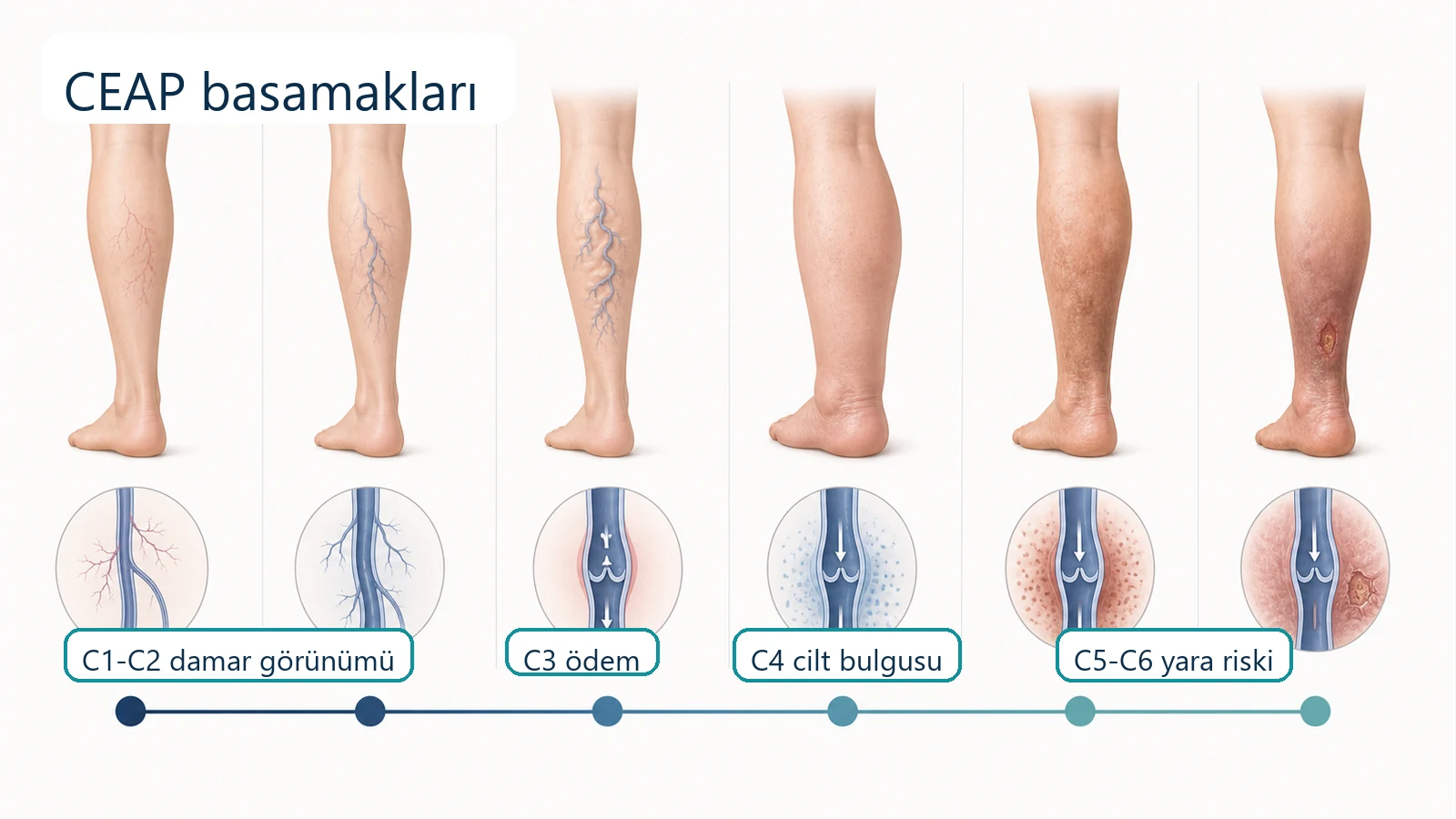 CEAP sınıflamasında kılcal damar, varis, ödem, cilt bulgusu ve yara riskinin görsel anlatımı.