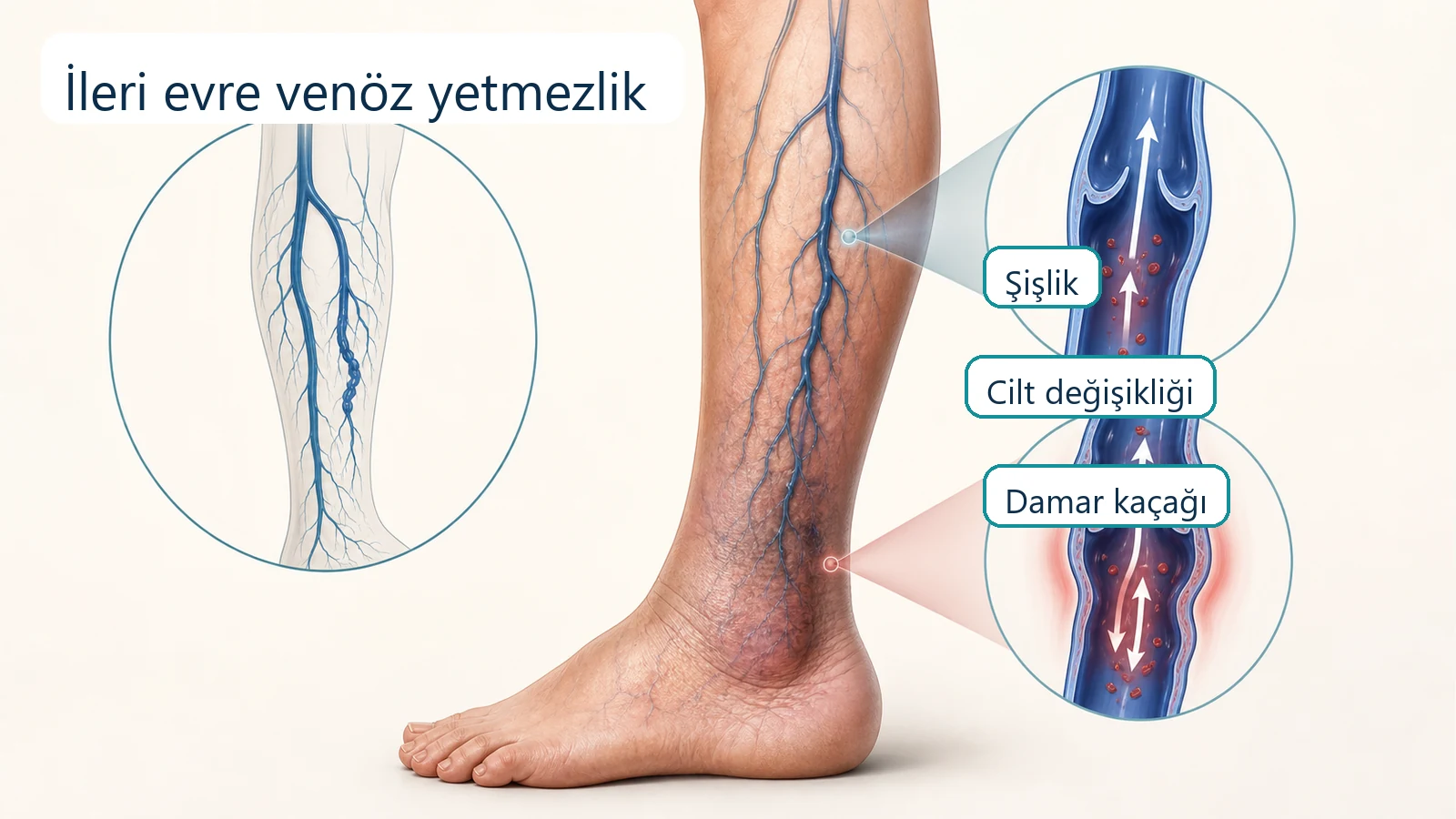 İleri evre venöz yetmezlikte bacak damar kaçağı, şişlik ve cilt değişikliği anlatımı.