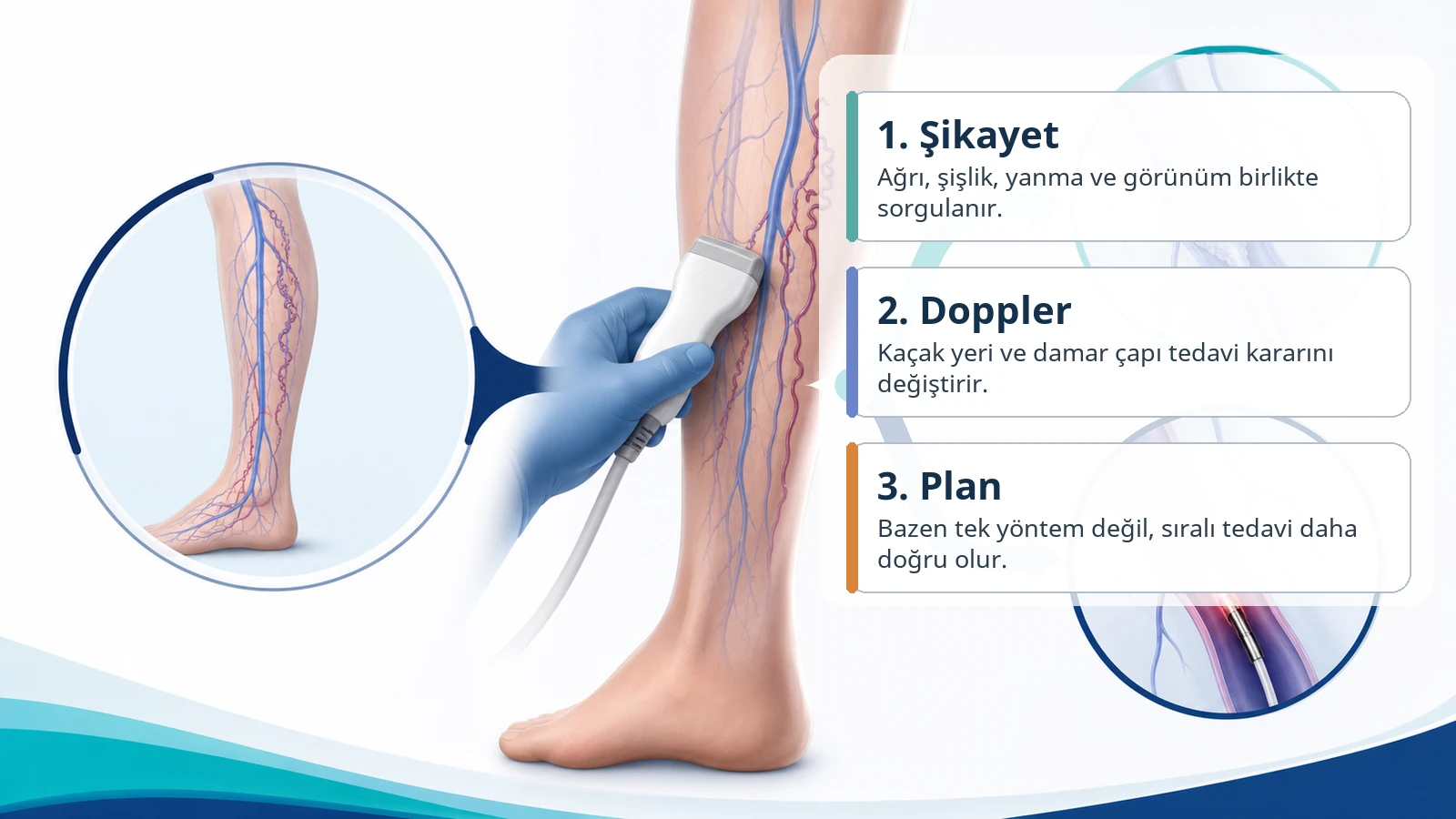 Doppler ultrason, şikayet ve damar çapına göre varis tedavi planını gösteren Türkçe açıklamalı medikal görsel