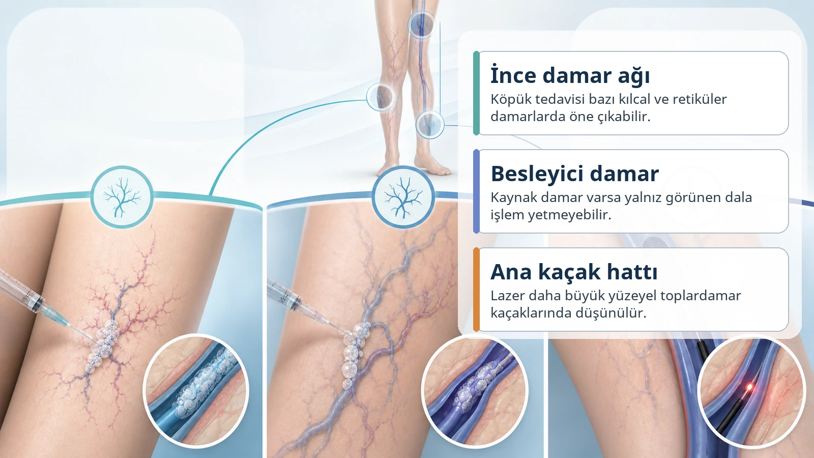 İnce damar ağı, besleyici damar ve ana kaçak hattına göre köpük veya lazer seçimini gösteren Türkçe açıklamalı medikal görsel