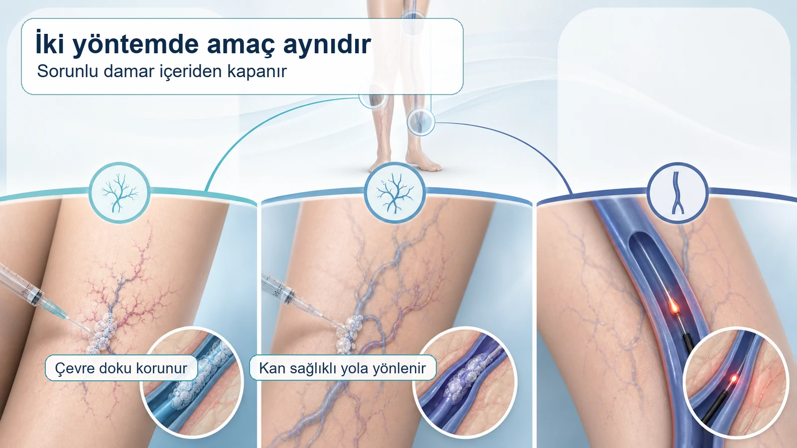 Lazer ve radyofrekans tedavisinde sorunlu toplardamar?n i?eriden kapat?lma mant???n? g?steren t?bbi ?ema.