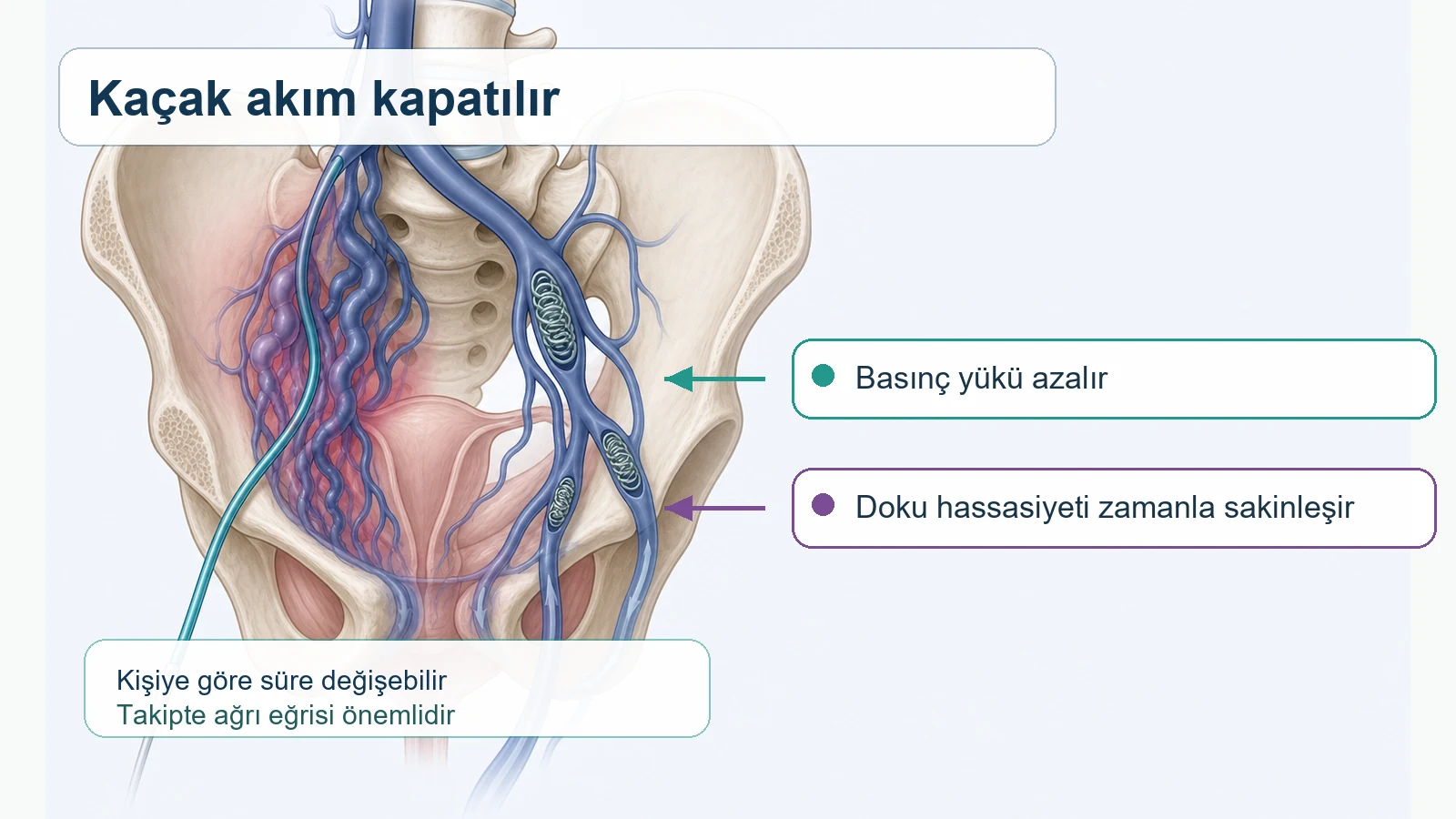 Pelvik ven embolizasyonunun kaçak akımı azaltarak ağrıyı hafifletme mantığını gösteren tıbbi şema.