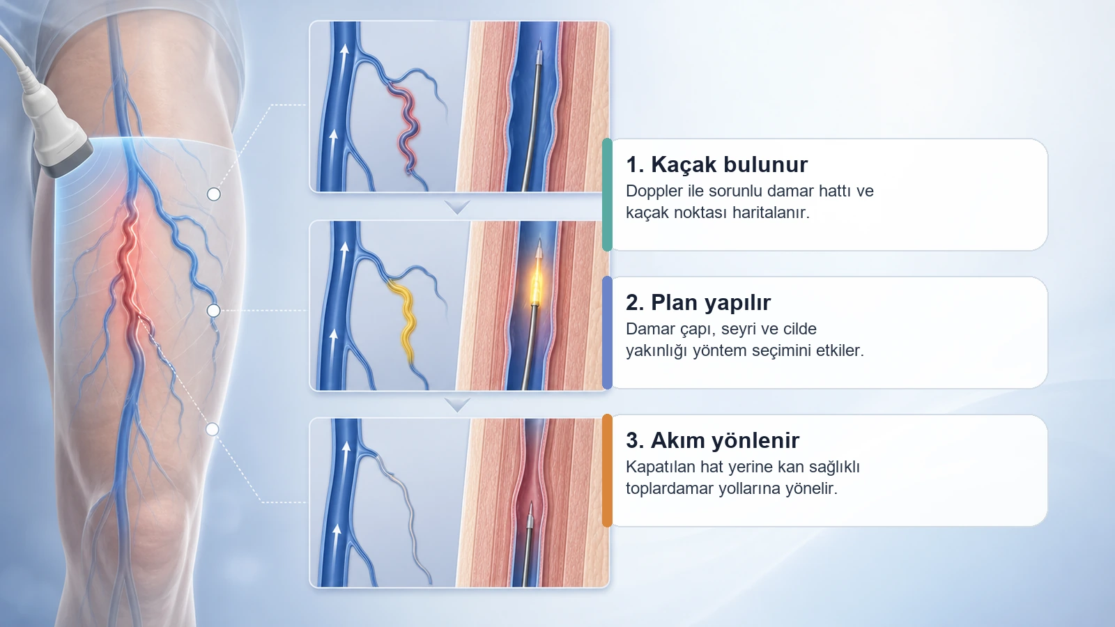 Radyofrekans ile Varis Tedavisi için Doppler haritalama, tedavi planı ve kan akımının yönlenmesini açıklayan premium medikal görsel