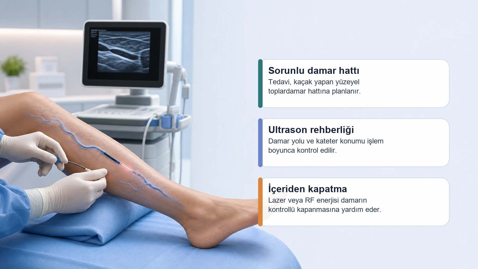 Radyofrekans ile Varis Tedavisi için varis tedavisinde sorunlu damarın ultrason rehberliğinde içeriden kapatılmasını açıklayan premium medikal görsel