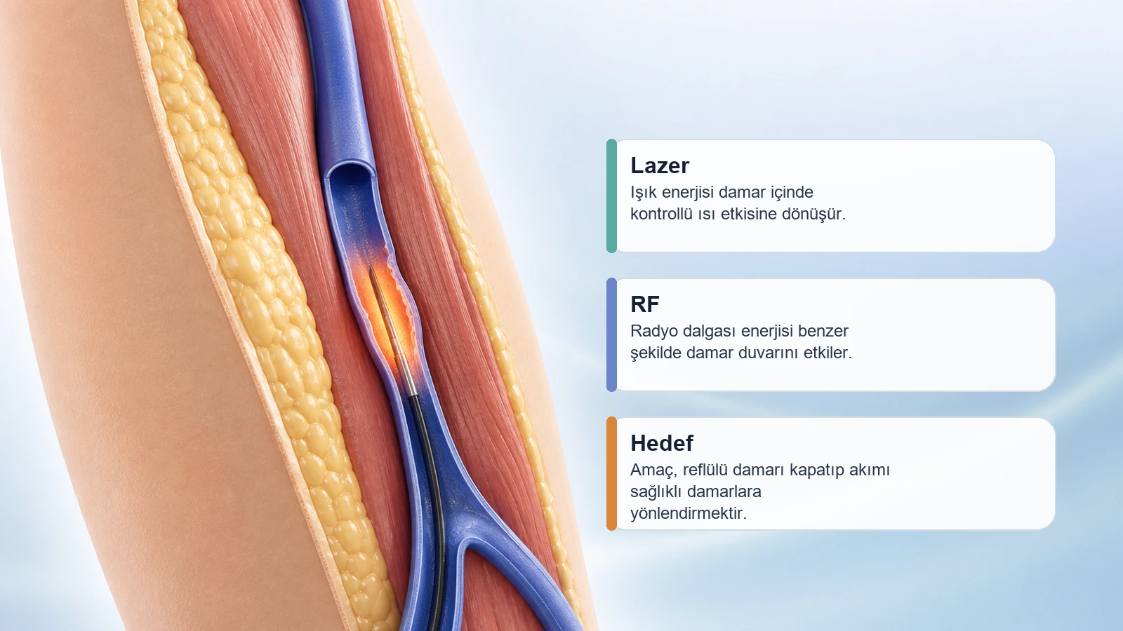 Radyofrekans ile Varis Tedavisi için lazer ve radyofrekans enerjisinin damar içinde nasıl etki ettiğini açıklayan premium medikal görsel