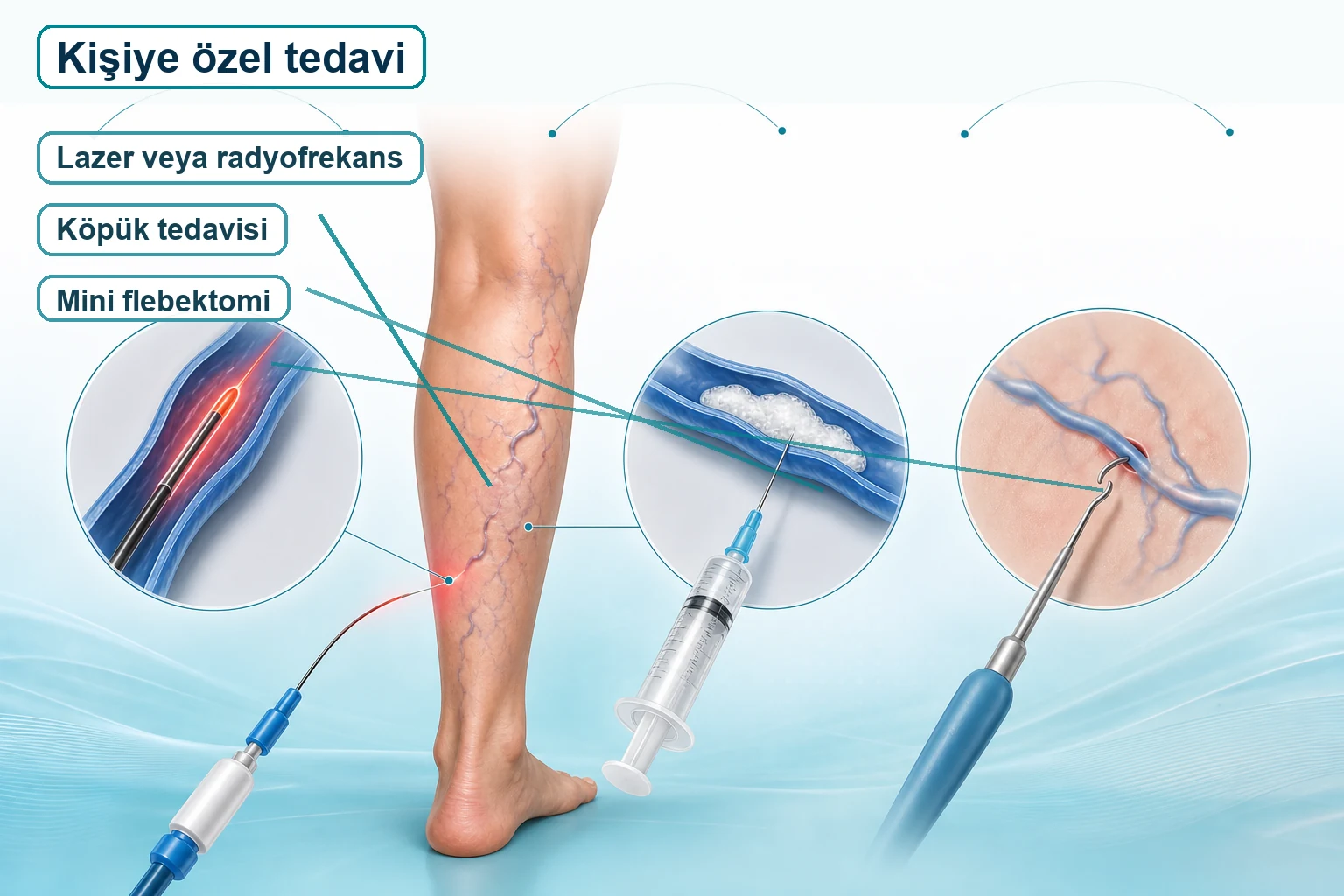Tekrarlayan variste lazer, radyofrekans, köpük tedavisi ve mini flebektomi seçeneklerini anlatan tıbbi görsel