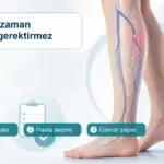 Ameliyatsız varis tedavisi için Doppler haritası, hasta seçimi ve damar yapısını anlatan tıbbi görsel