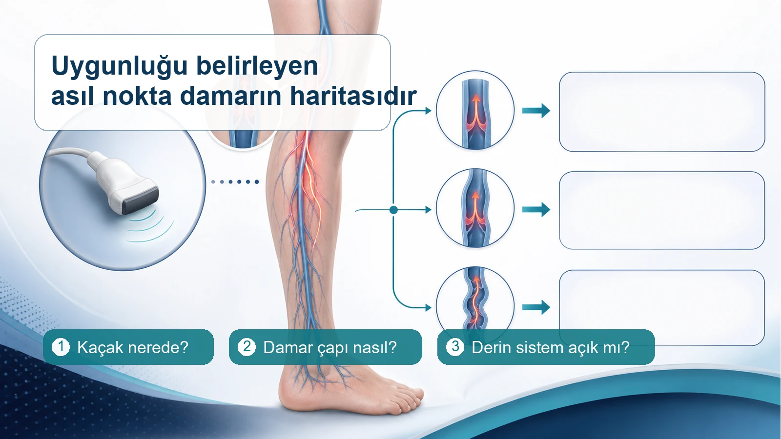 Doppler ultrasonla varis kaçağının yeri, damar çapı ve derin sistem açıklığının değerlendirildiğini gösteren tıbbi şema