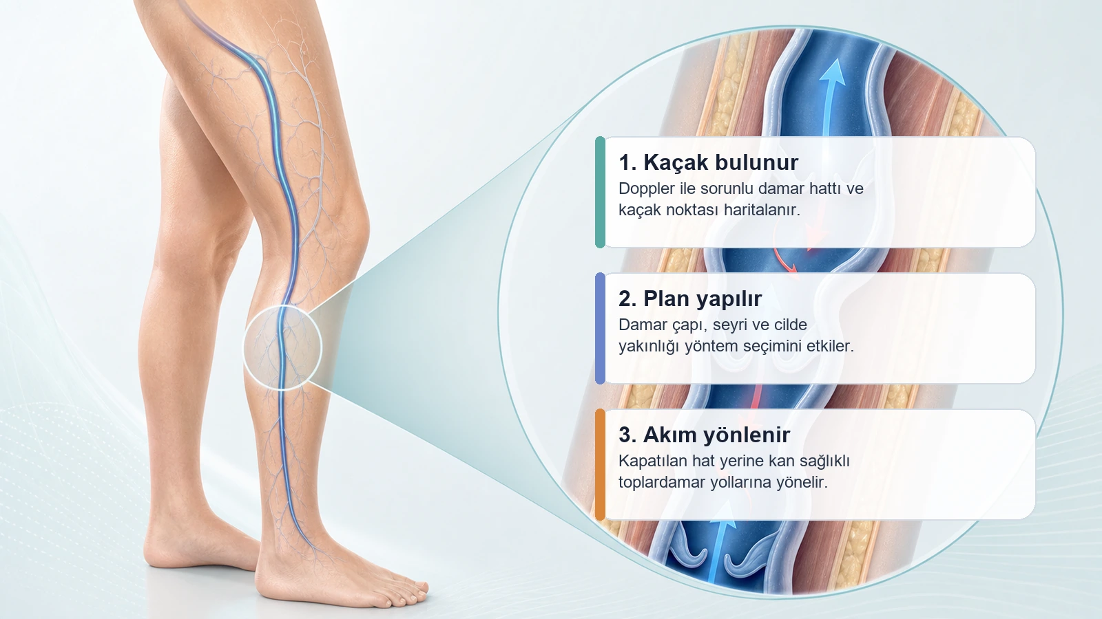 Varis Dopplerinde Safen Ven Yetmezliği Ne Anlama Gelir? için Doppler haritalama, tedavi planı ve kan akımının yönlenmesini açıklayan premium medikal görsel