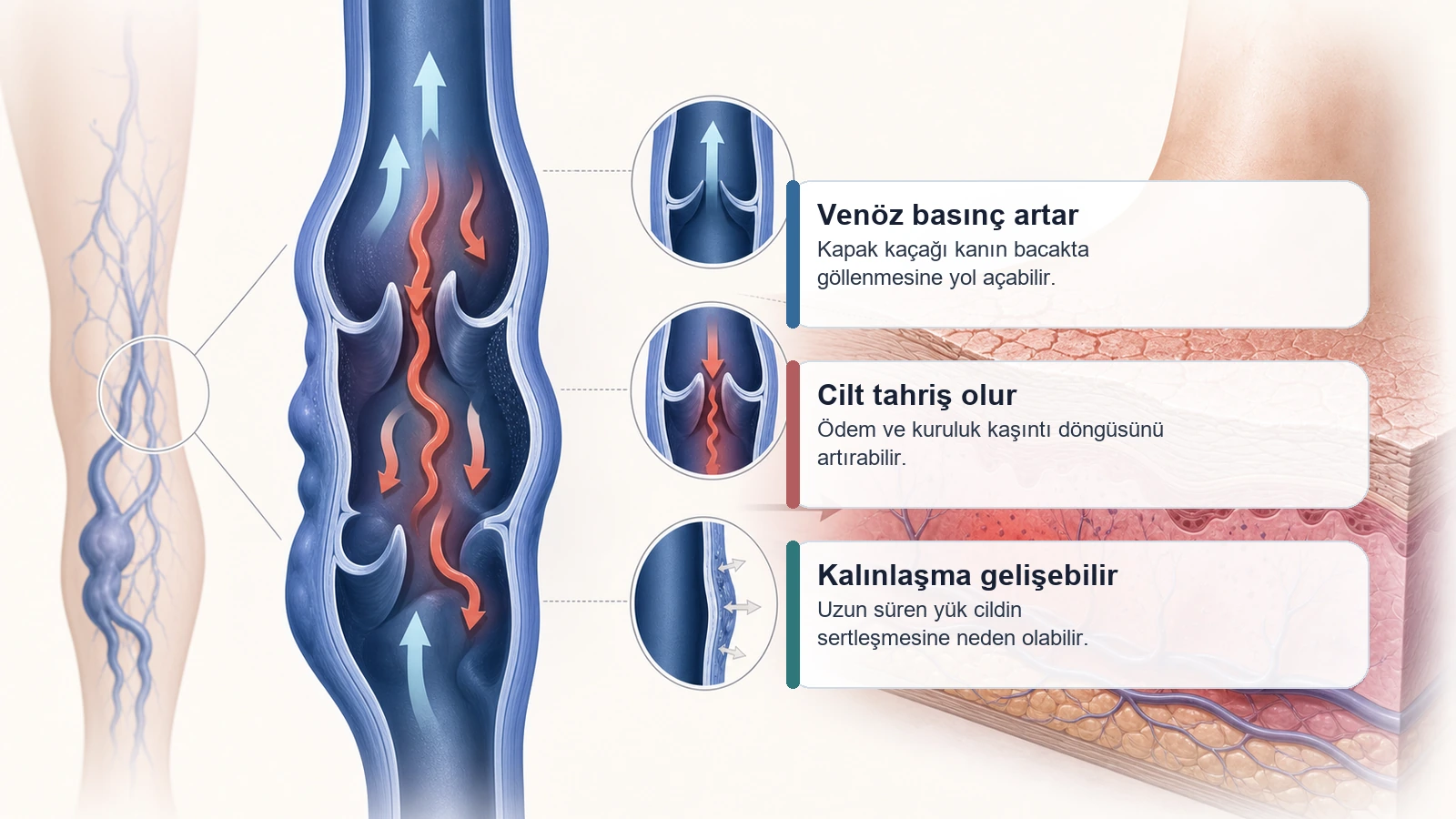 Venöz basınç artışının dermatit ve ciltte renk değişikliğiyle ilişkisini anlatan medikal görsel