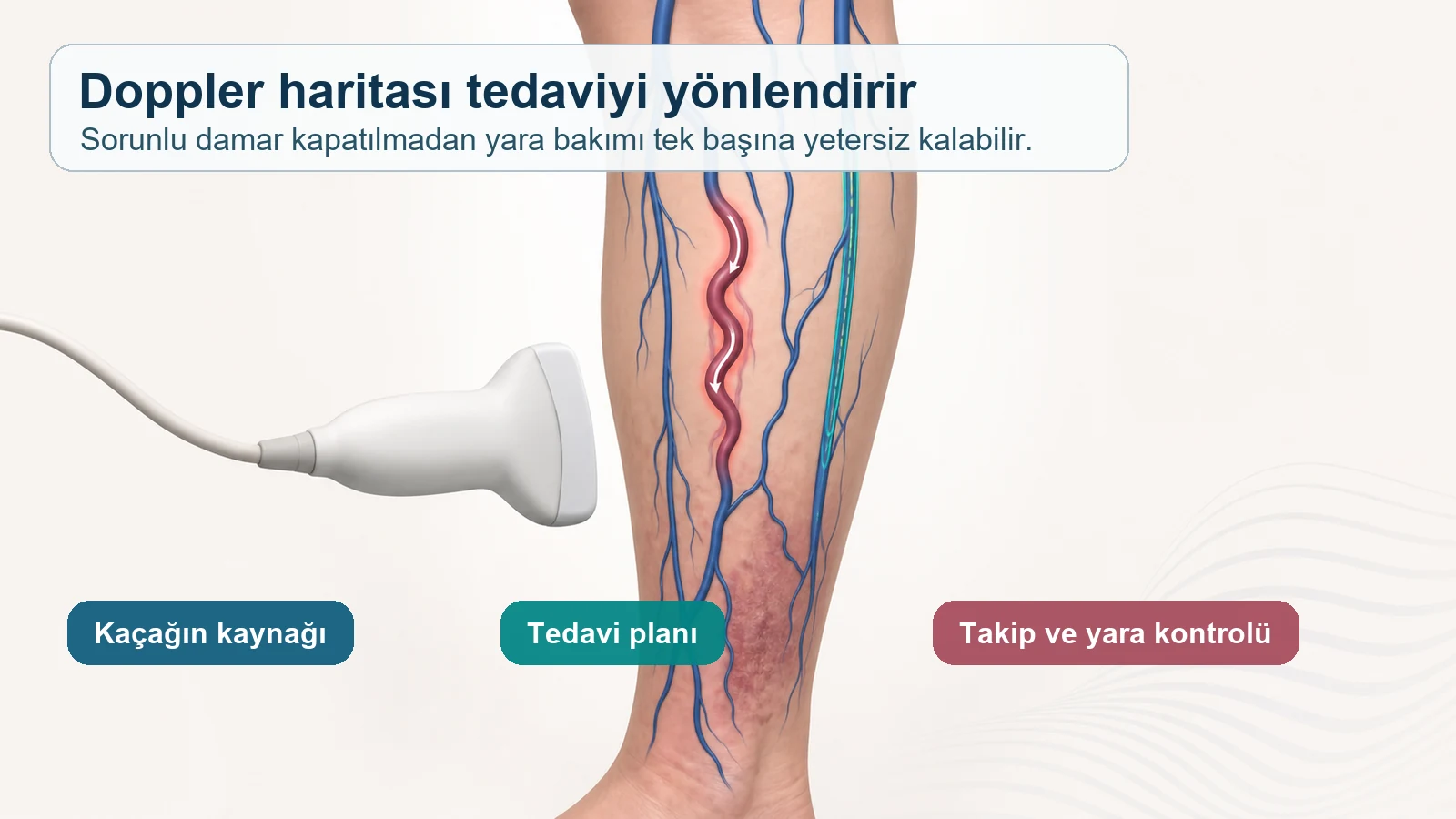 Doppler ile kaçak damarın haritalanmasını ve tedavi planının belirlenmesini anlatan varis yarası görseli