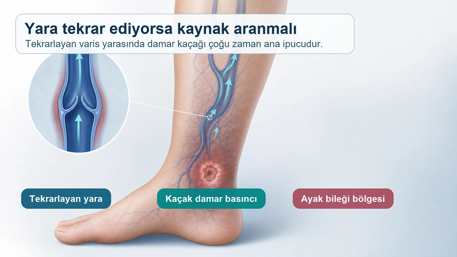 Tekrarlayan varis yarasında ayak bileği bölgesine basınç taşıyan damar kaçağını gösteren medikal illüstrasyon