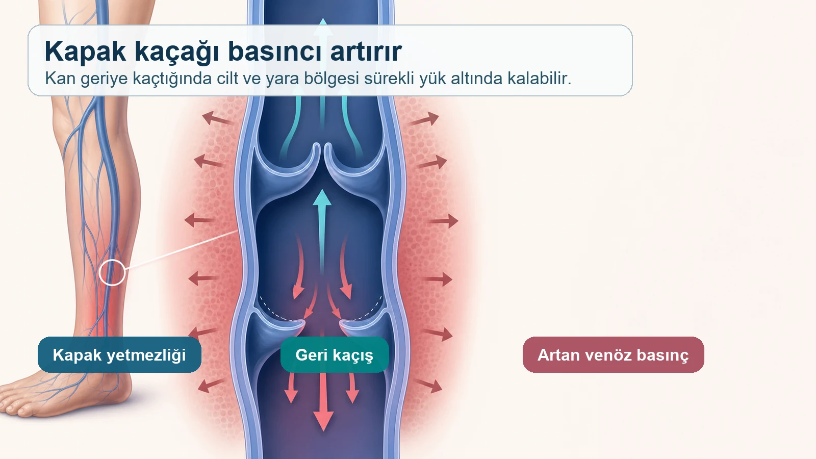 Toplardamar kapak kaçağının geri kaçış ve artan venöz basınca yol açmasını gösteren medikal mekanizma görseli