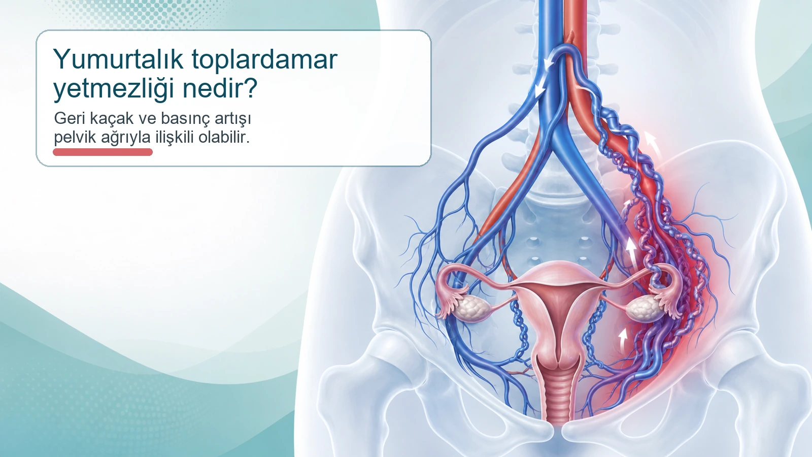 Yumurtalık toplardamar yetmezliğini ve pelvik venöz kaçak mekanizmasını gösteren tıbbi illüstrasyon