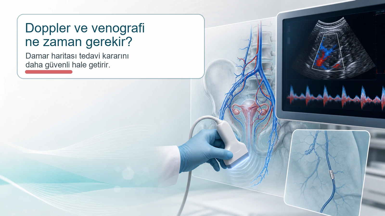 Doppler ve venografi ile pelvik venöz damar haritasını anlatan tıbbi illüstrasyon