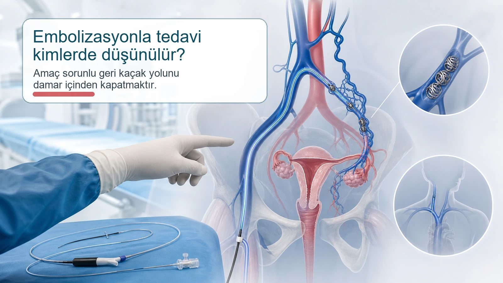 Yumurtalık toplardamar yetmezliğinde embolizasyon tedavi planlamasını gösteren tıbbi illüstrasyon