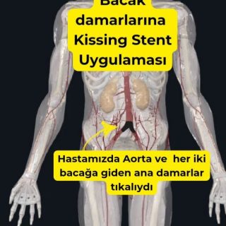 Tıkalı iliak damarlarda kullanılan "kissing stent" yöntemi, özellikle pelvik bölgede (kalça altı böl…